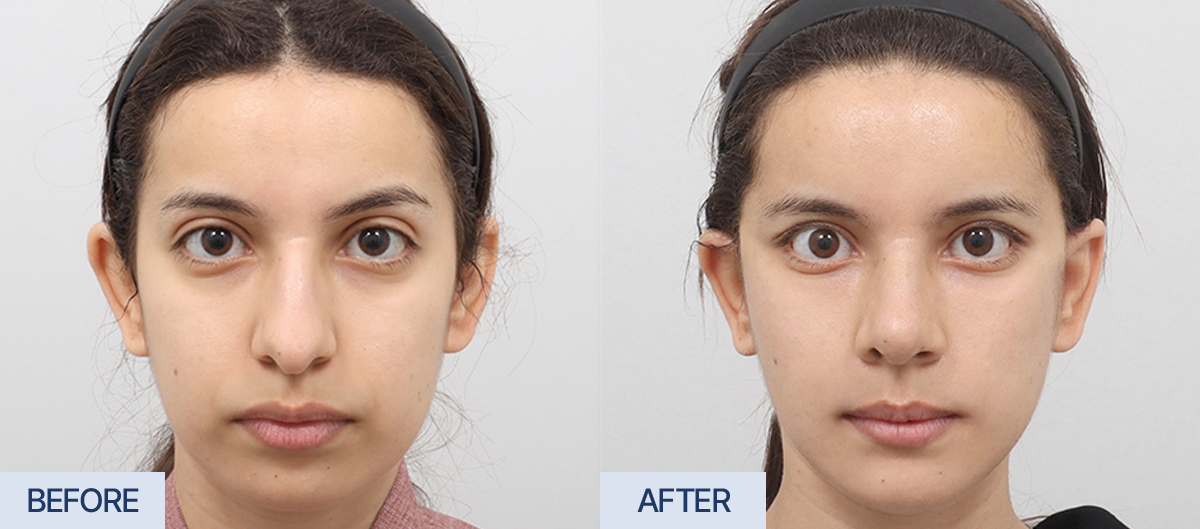 AB Plastic Surgery Before and After Review