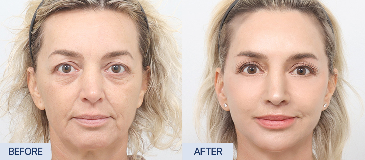 AB Plastic Surgery Before and After Review