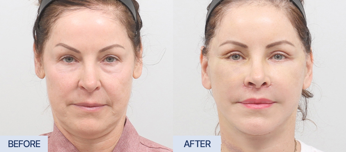 AB Plastic Surgery Before and After Review